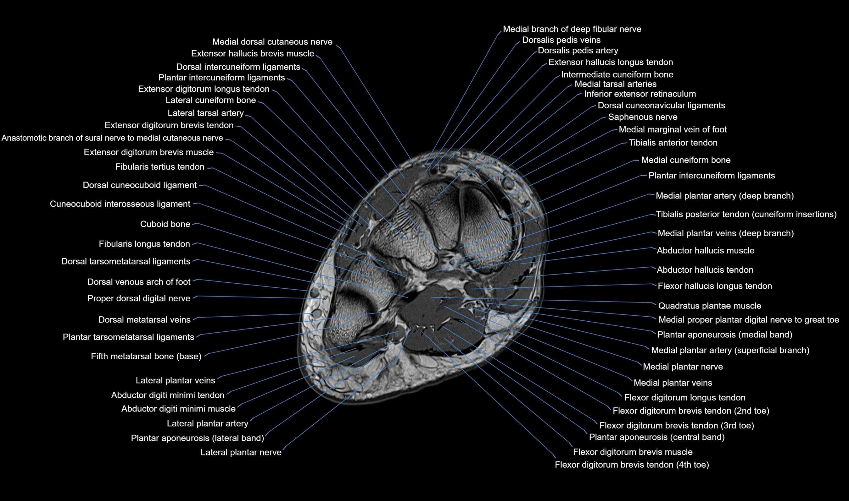 MRI mid foot axial cross sectional anatomy 3T  radiology  image-img-00001-00023.webp